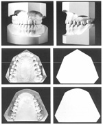 Modele gipsowe – podstawowy materiał diagnostyczny w stomatologii