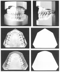 Model diagnostyczny przycięty wg zasad zawartych w „Orange Book” Amerykańskiej Rady Ortodontycznej (The American Board of Orthodontics)